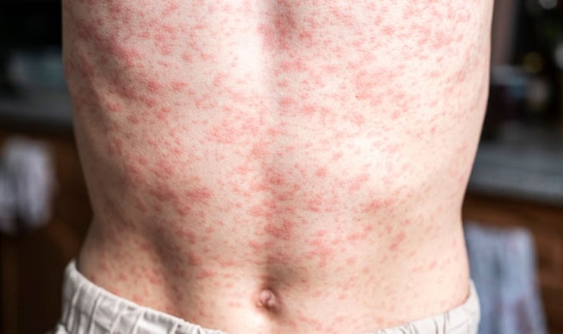 América pierde su estatus de región libre de sarampión, anuncia la OPS